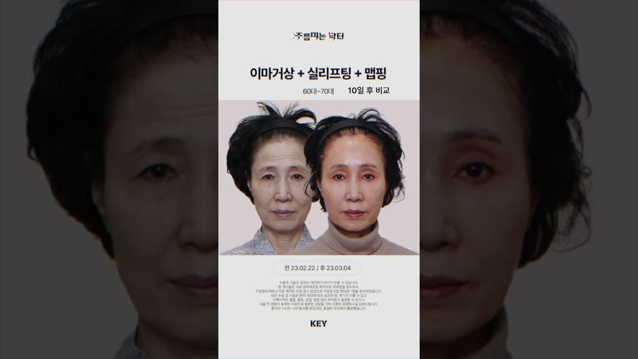 6070대 장모님께 직접 해드린, 이마거상술 대구키성형외과