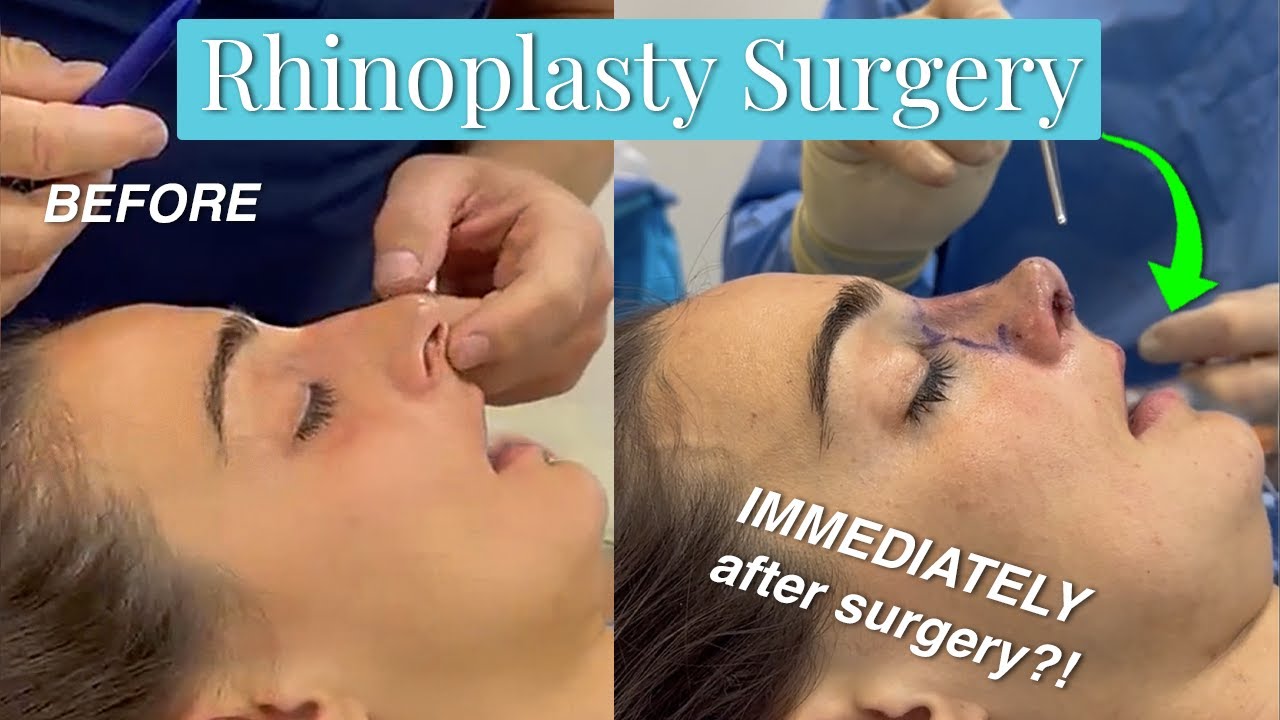 Revision Rhinoplasty | Dr. Chasan