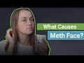 What Causes Meth Face?