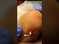 What S Stuck In The Toe Podiatry Popping