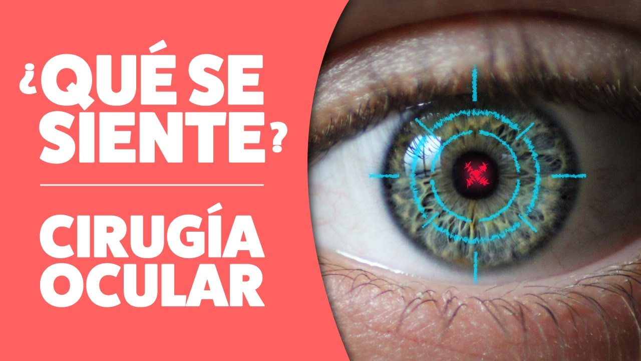 Así es REALMENTE la CIRUGÍA Refractiva Láser ¿Vale la Pena