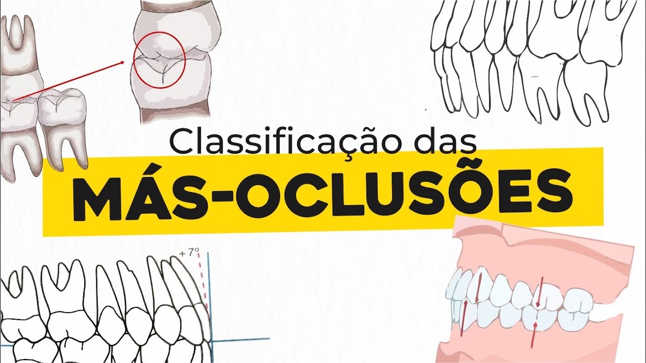 Classificação das más oclusões | ORTODONTIA
