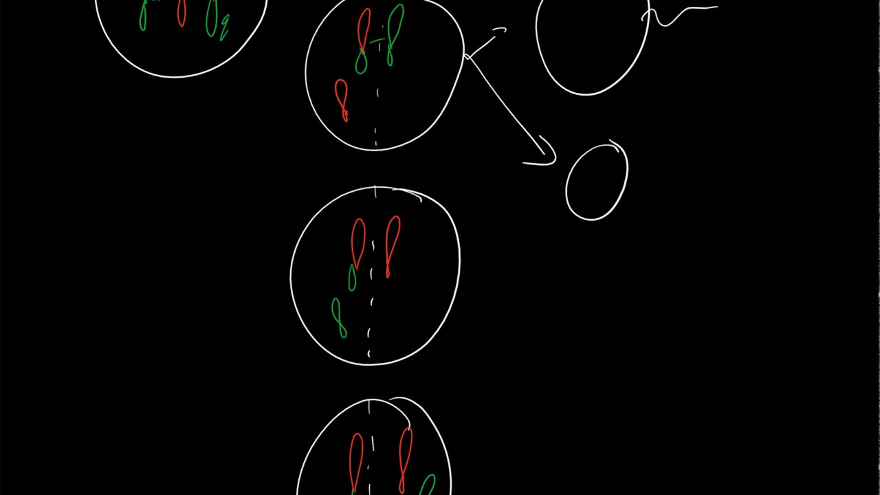 Robertsonian translocation: 21q14q
