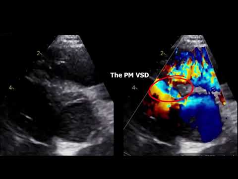 Double chamber right ventricle echocardiography (DCRV).