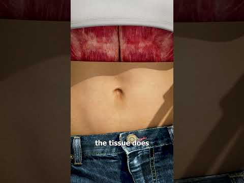 What Causes An Outie Belly Button? 🤔