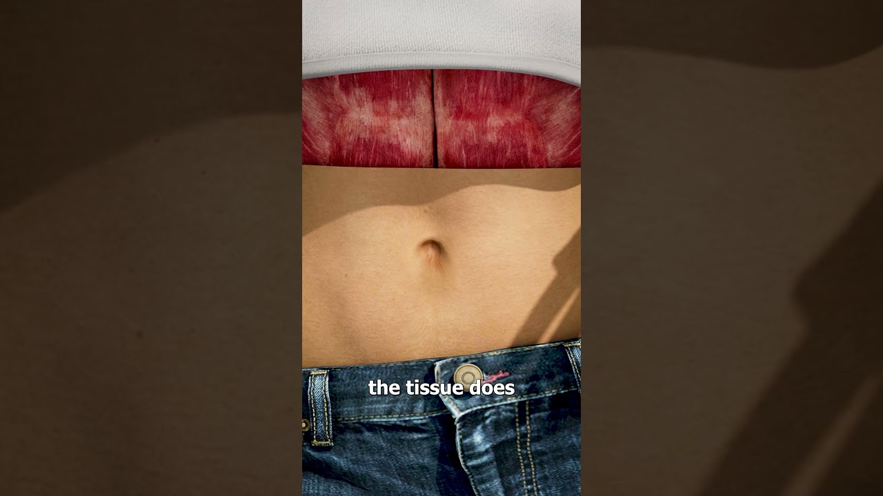 What Causes An Outie Belly Button? 🤔