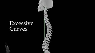 Osteoporosis - Excessive Curves
