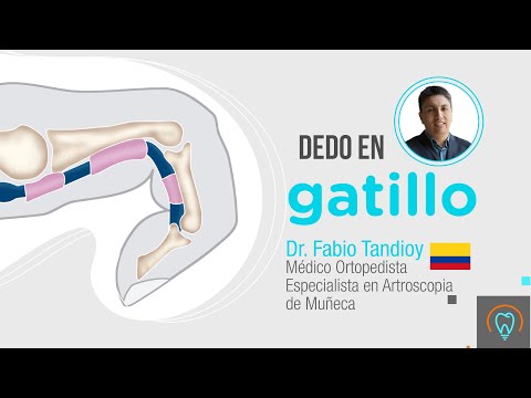 Dedo en Gatillo | Tu Salud Guía