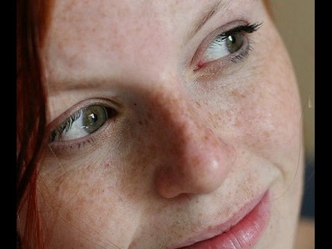 Можно ли избавиться навсегда от веснушек Флоресан корректор пигментных пятен