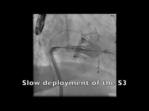 Mitral ViV S3 transseptal