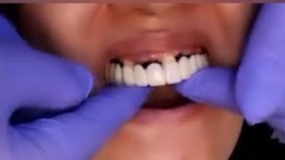 Download lagu gigi palsu nyaman lepas pasang lamgsung pake.tamu dr binjai mp3 Download lagu gigi palsu nyaman lepas pasang lamgsung pake.tamu dr binjai mp3