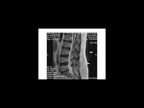 Progression Of Degenerative Disk Disease - Lumbar Spine MRI