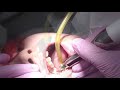 Achieving immediate and painless anesthesia for children with Quicksleeper5