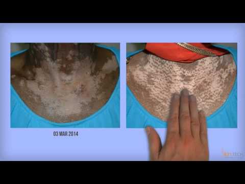 Vitix Gel for Vitiligo