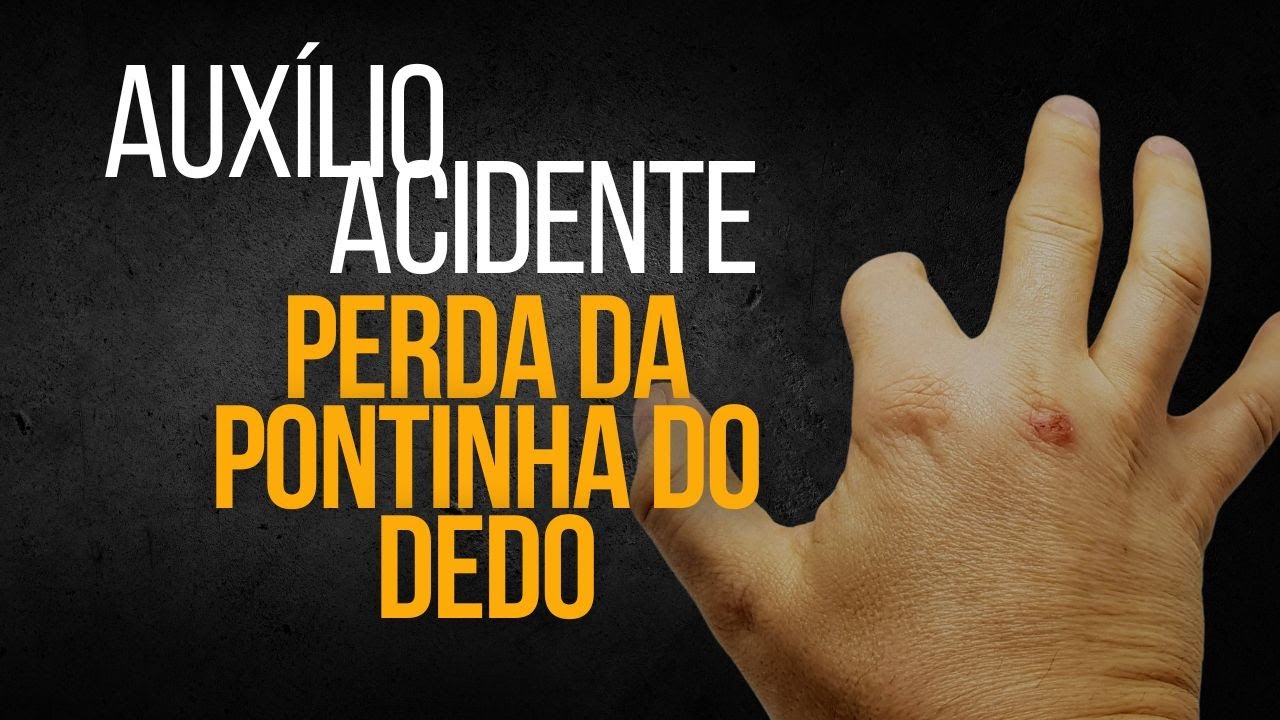 AUXÍLIO ACIDENTE: PERDA DA PONTINHA DO DEDO #inss #beneficioprevidenciario