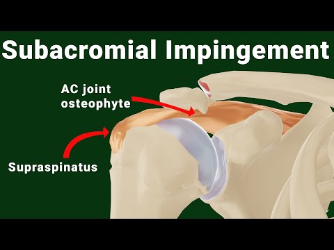 Subacromial impingement of the shoulder (animated)