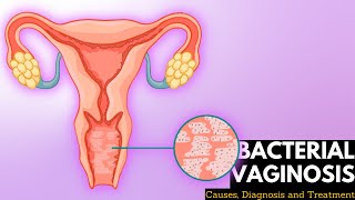 Bacterial vaginosis, Causes, Signs and Symptoms, DIagnosis and Treatment.