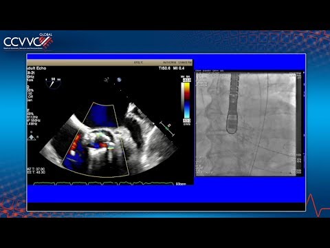 Evolut-PRO TAVR - 2018 CCC Live Case 7