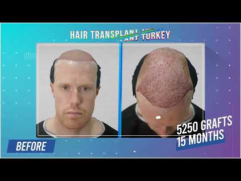 5250 Grafts Hair Transplant Result | Natural Hair Restoration in Istanbul with Dr. Ekrem Keskin