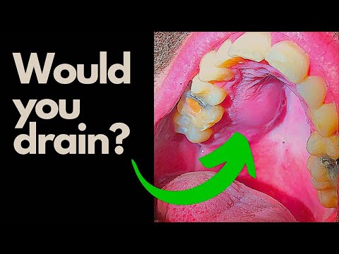 Tooth Abscess - Would You Incise and Drain This Abcess?