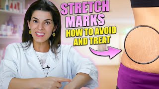 STRETCH MARKS - Differences, Causes and Treatments for White, Purple and Red Stretch Marks