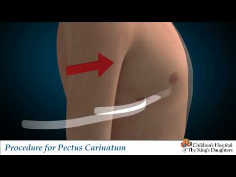 CHKD Carinatum