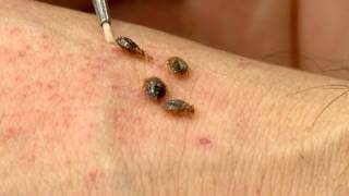 From the Headlines: Bed Bugs with Louis Sorkin
