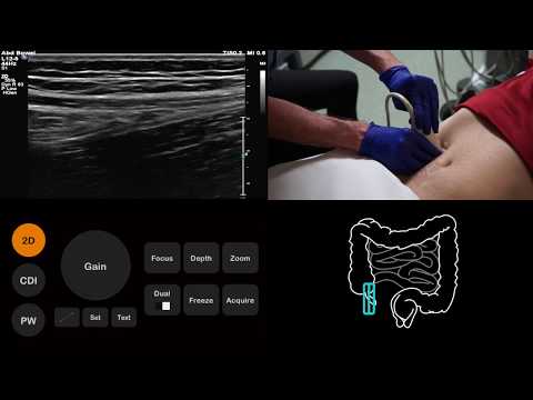Ultrasound Tutorial: Appendix/Appendicitis | Radiology Nation