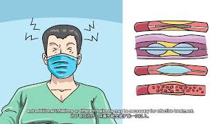 Fistuloplasty for Hemodialysis Access Maintenance