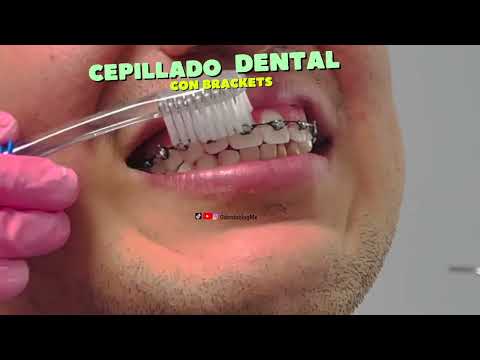 CEPILLADO DENTAL CON BRACKETS