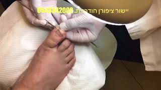 טיפול מקצועי בציפורן חודרנית,יישור ציפורן