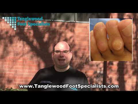 YouTube video about: Can athlete's foot cause plantar warts?