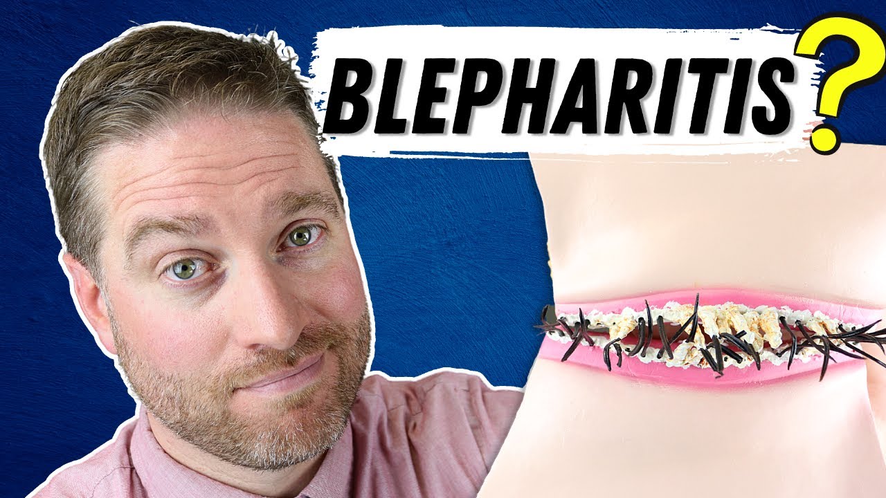 Watch video What Is Blepharitis (Blepharitis Explained - Best Treatments) Now What Is Blepharitis (Blepharitis Explained - Best Treatments)
