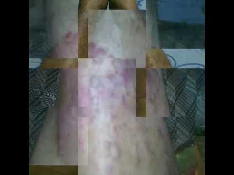 ฟอรั่มโรคสะเก็ดเงิน Palmar-ฝ่าเท้า เลซิตินที่ถ่ายในโรคสะเก็ดเงิน