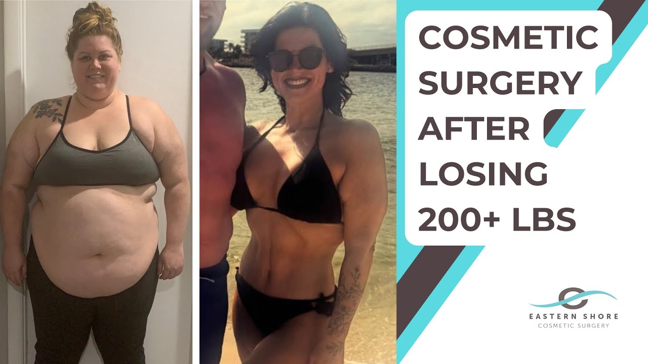 After Losing 200+ Pounds, Cosmetic Surgery is More Than a “Vanity Thing”