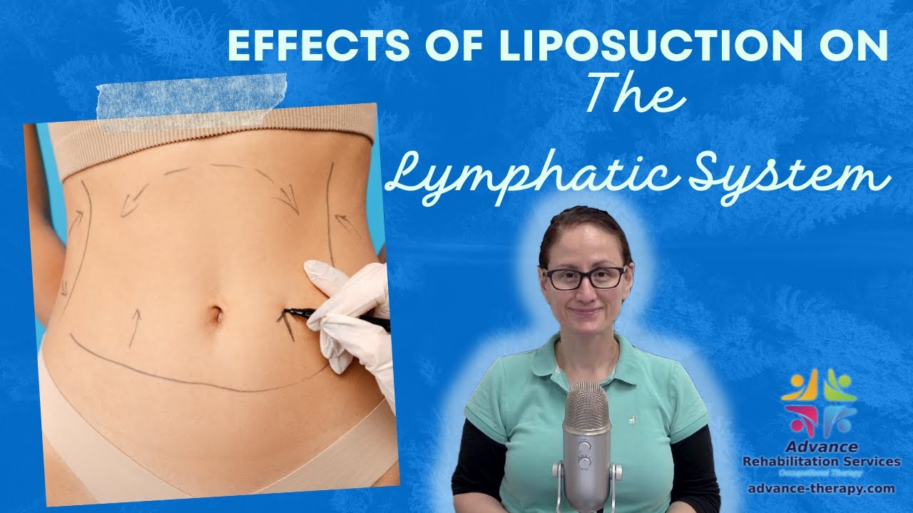 Effects of Liposuction on The Lymphatic System (Lymphedema)