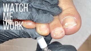 Detailed pedicure with e-file, chronic onycholysis.