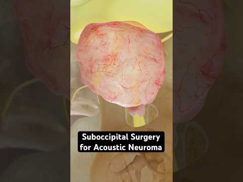 Entfernung eines Tumors aus Ihrem Ohr (3D-Animation)