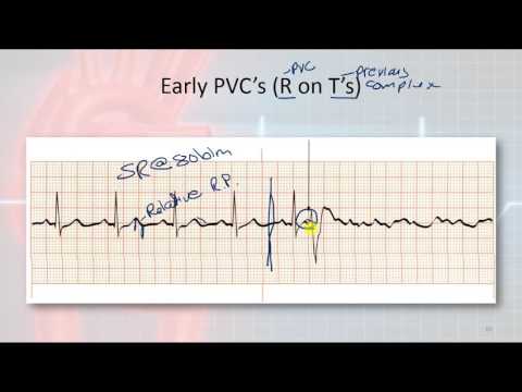 Basic Electrophysiology, part 9 - Ventricular Rhythms