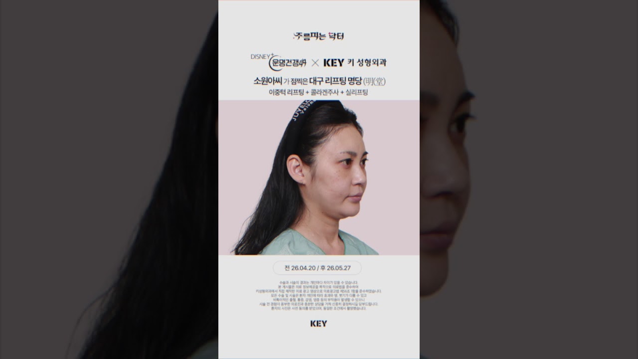 소원아씨 이중턱리프팅