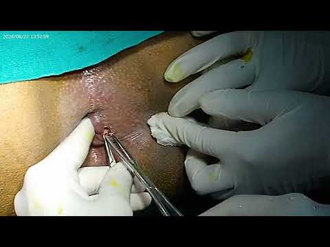 Operative case Naresh MOLIS video