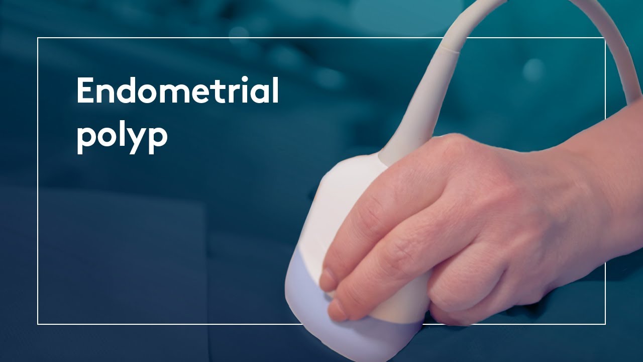 What is an Endometrial polyp? - YouTube
