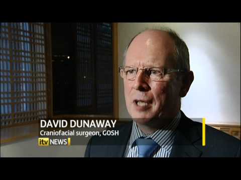 Conjoined twins operation