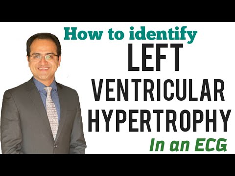Left Ventricular Hypertrophy ECG Changes (Skolow Lyon Criteria) Explained, ECG Lectures USMLE NEETPG