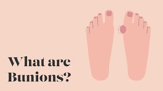 What are Bunions | TheWalkingCompany | Keep On Walking