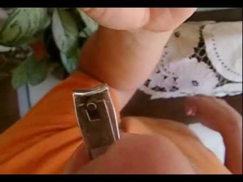 Kaysa sa paggamot ng kuko halamang-singaw paggamot thumb binti Sinaunang pamamaraan ng paggamot ng kuko halamang-singaw