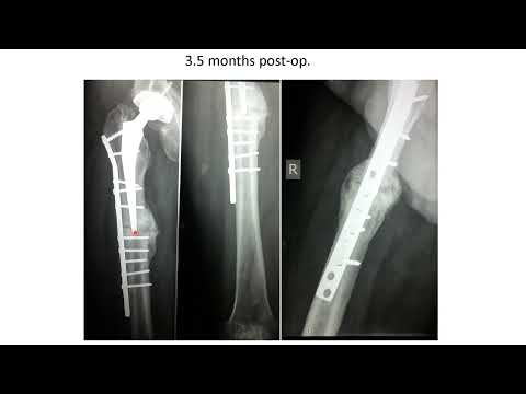 Plate fixation for type B1 Vancouver periprosthetic Fr, clinical presentation.