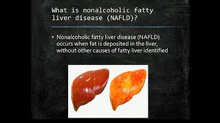 Fatty Liver: The Silent Epidemic