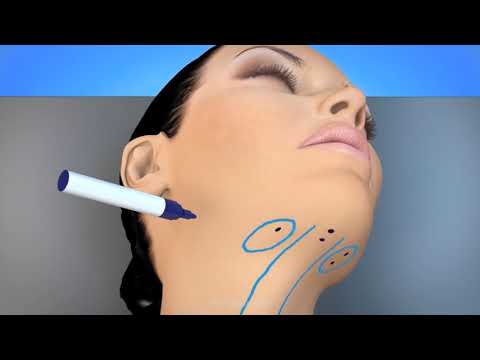 Animation of the MyEllevate® Procedure