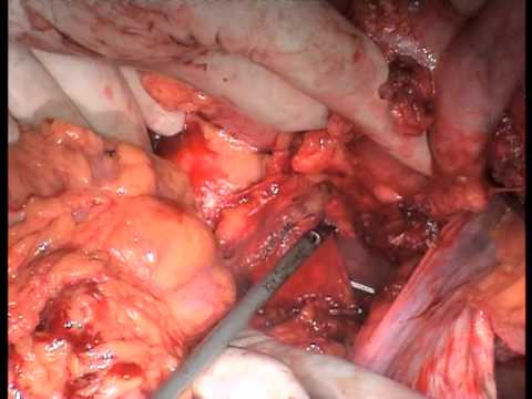 Esophageal cancer surgery, Radical Esophagectomy
